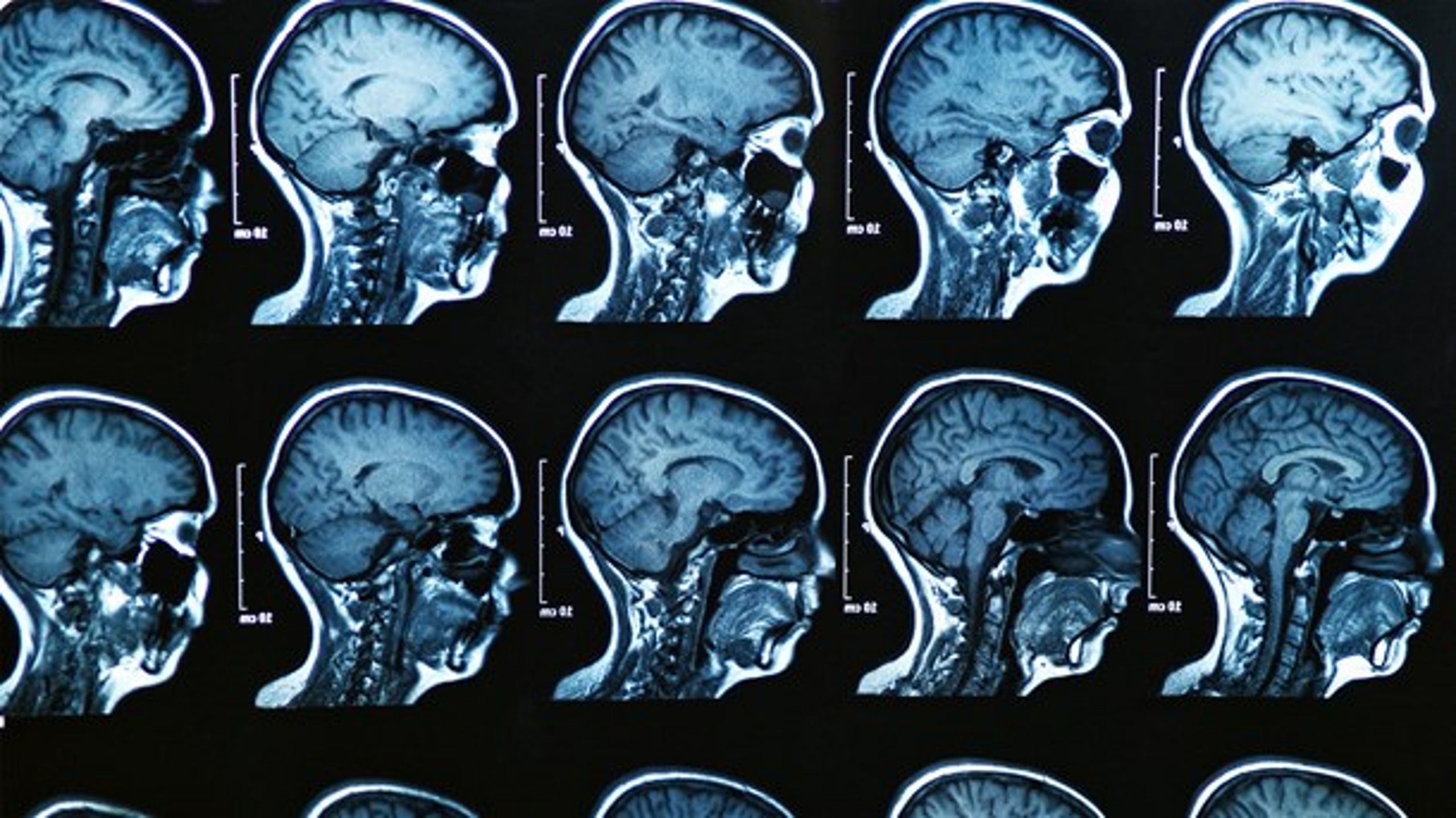 SUPERSYG: Dygtigt personale kæmper en ulige kamp i et sundhedssystem, der virker tiltagende afpillet, skriver Johanne T. Dalgaard.