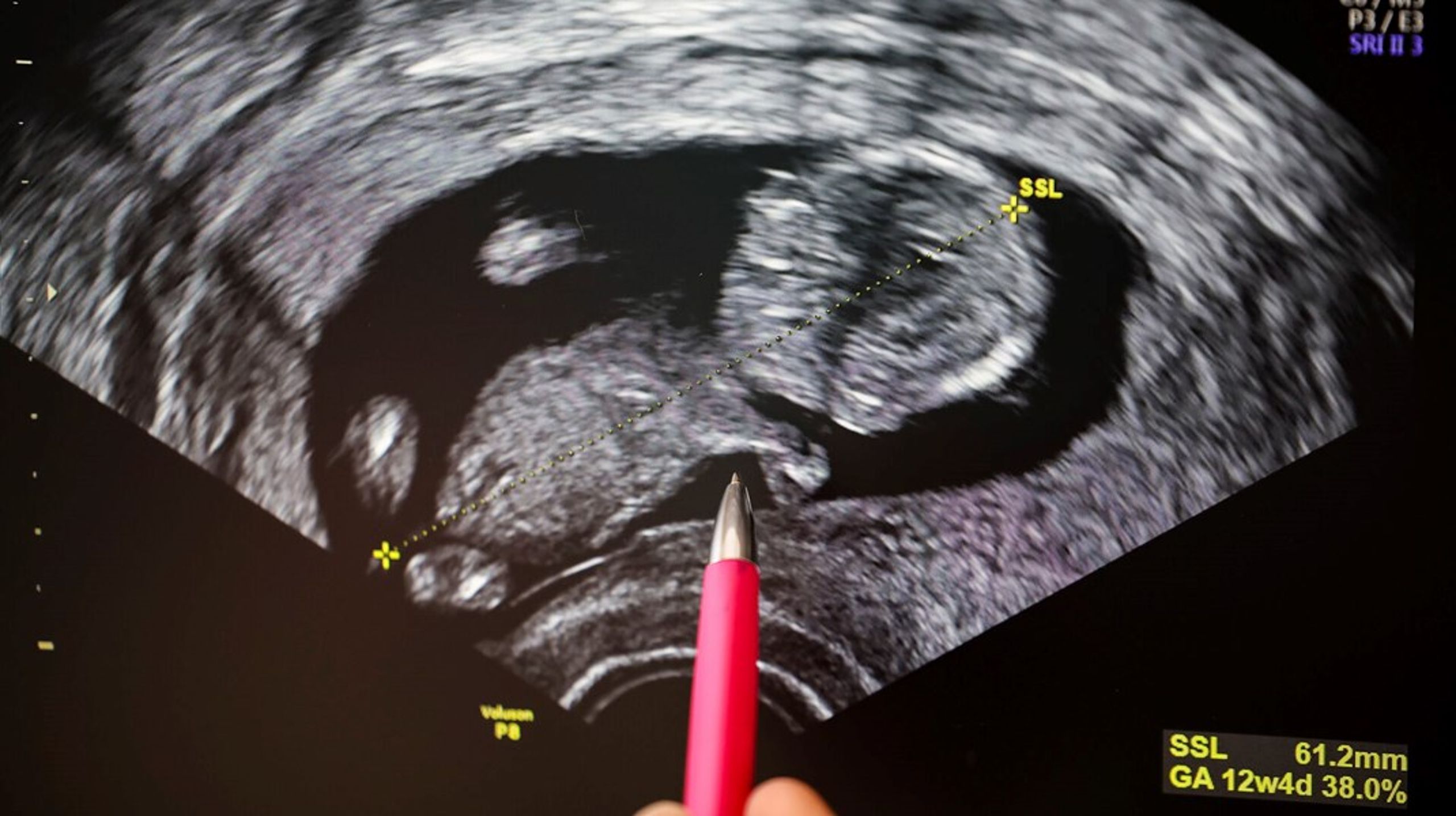 Nyfødte børn vejer mindre, hvis deres mor har været udsat for høje værdier af PFAS i drikkevandet under graviditeten, viser ny analyse.