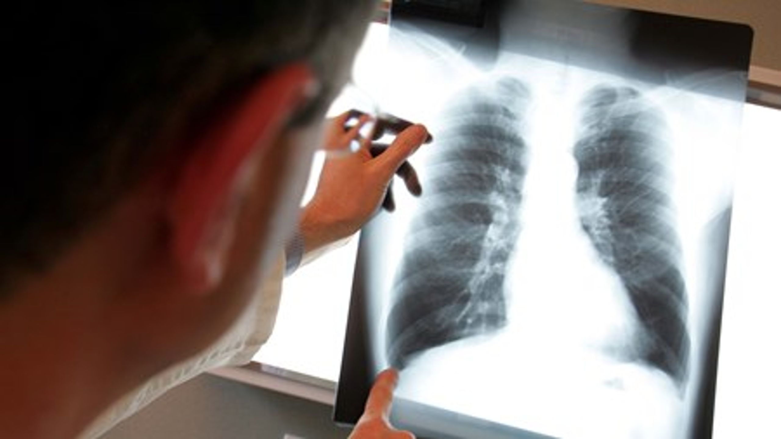 Sundhedsstyrelsens hurtige beslutning om at revidere nogle af retningslinjerne bag lungesatsning udløser ros fra kritikerne af retningslinjerne fra december 2015.&nbsp;